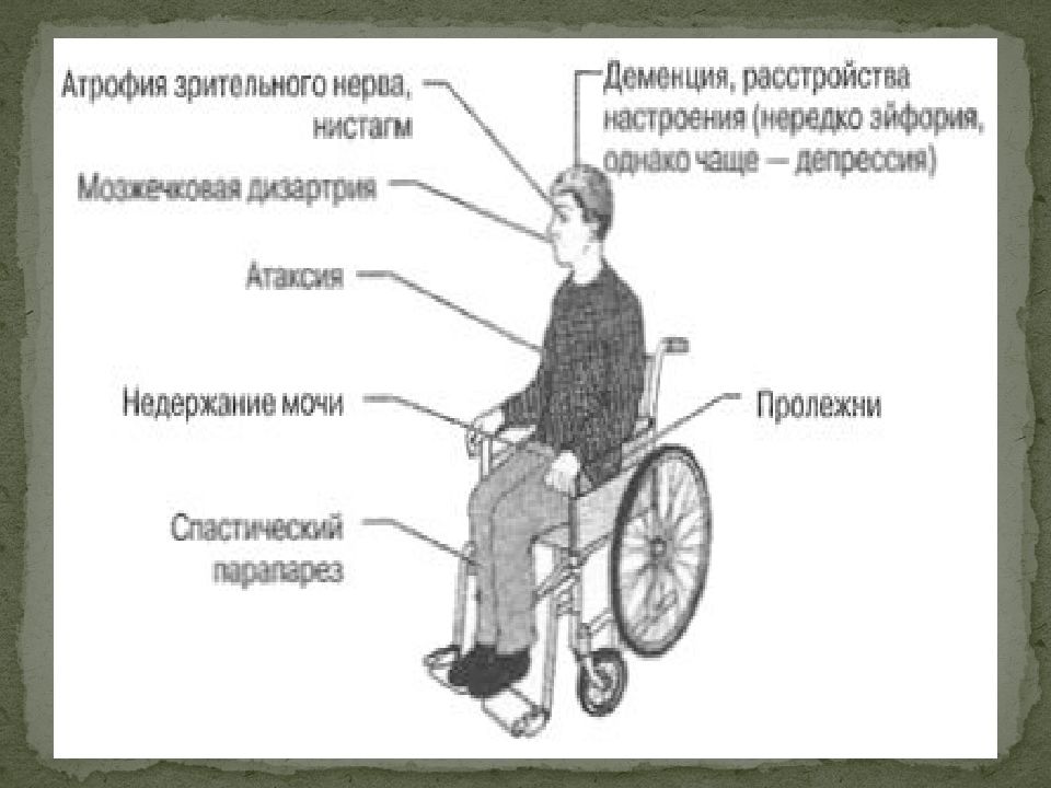 Склероз симптомы у мужчин на ранних стадиях. Рассеянный склероз. Рассеянный склероз презентация. Рассеянный склероз слайд. Рассеянный склероз инвалид.