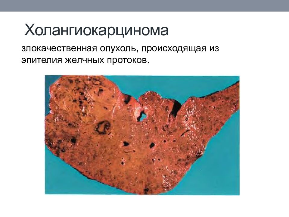 Холангиокарцинома печени патологическая анатомия. Холангиоцеллюлярная карцинома печени. Холангиокарцинома желчных протоков. Опухоль желчевыводящих протоков.