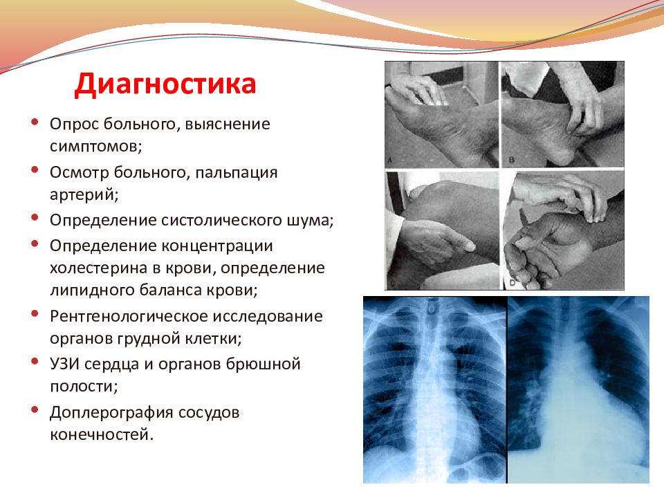 Атеросклероз — презентация