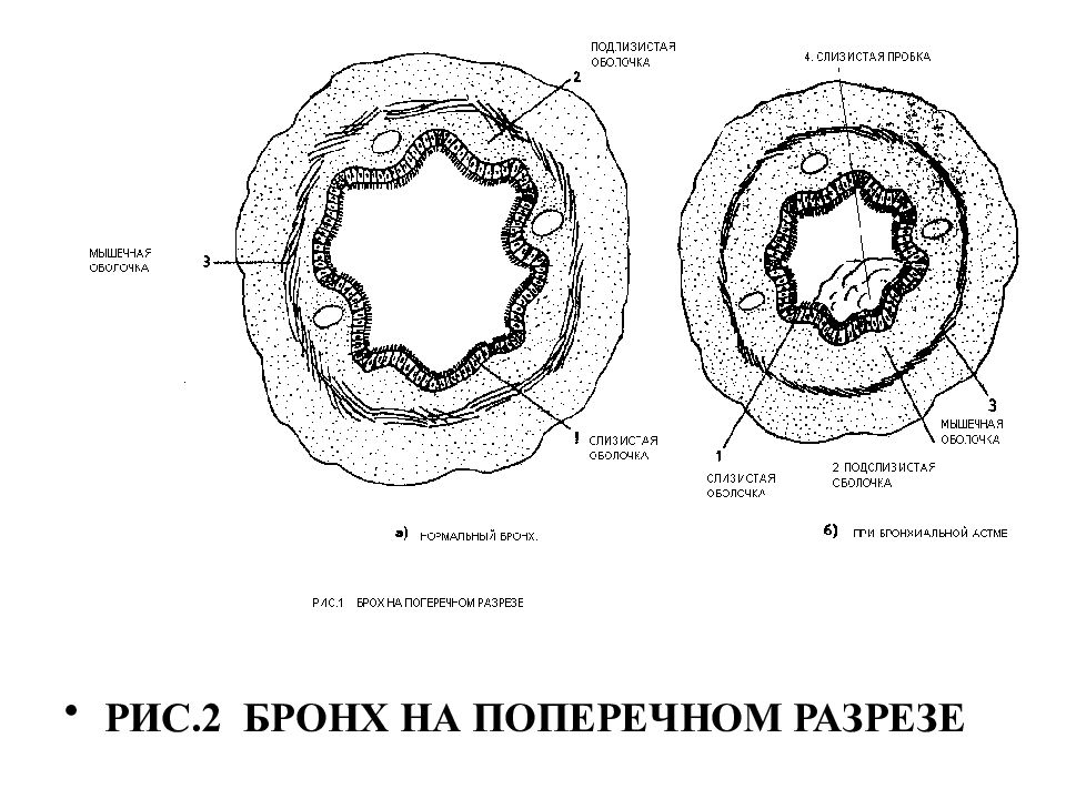 Стенки бронхов. Строение стенки бронхов. Бронхиальная астма микропрепарат рисунок. Строение стенки бронхов анатомия. Строение стенки бронза.