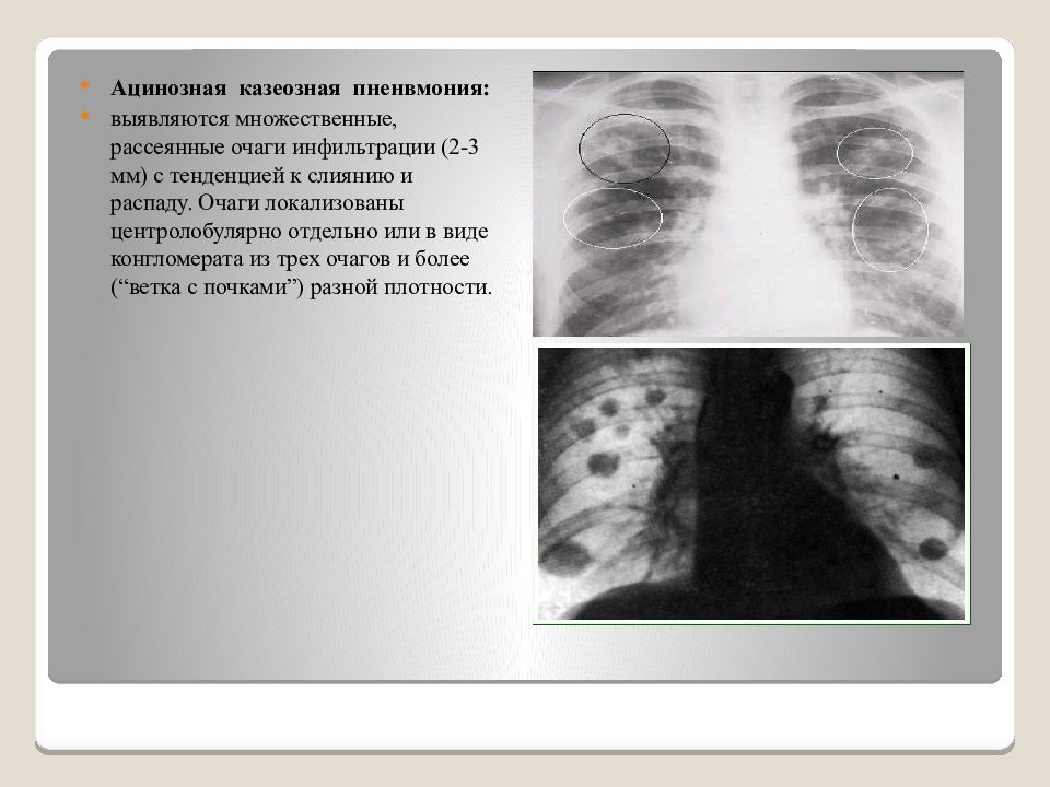 Казеозная пневмония презентация