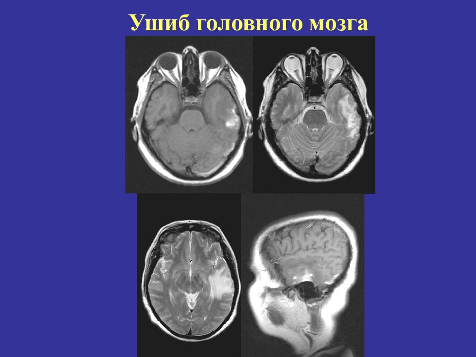 Ушиб головного мозга. Черепно мозговая травма кт и мрт. Ушиб головного мозга на компьютерной томографии.