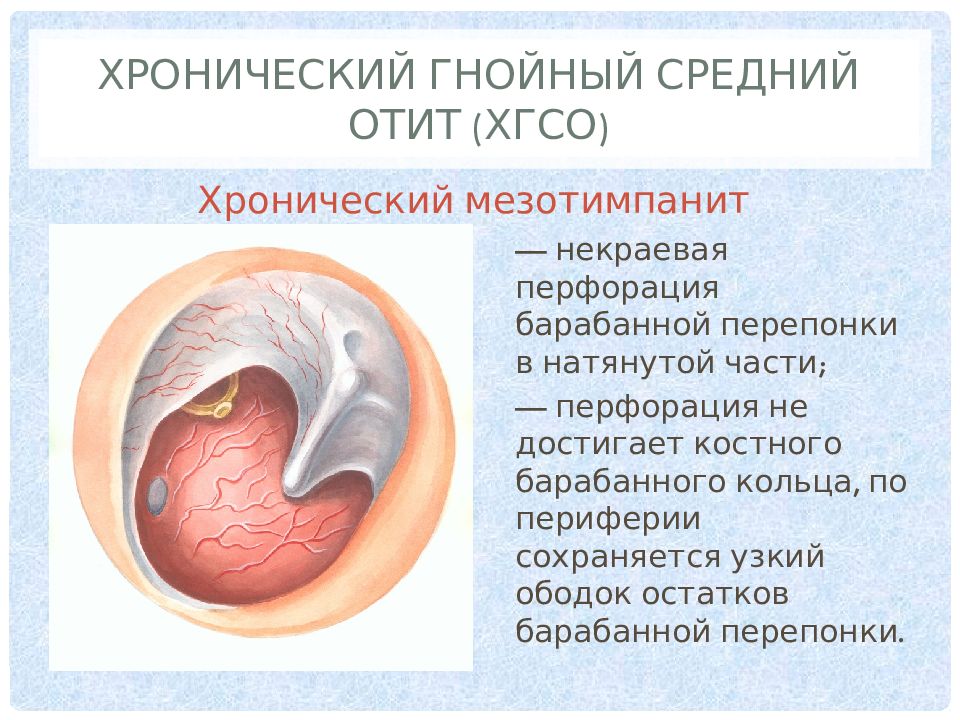 Острый диффузный наружный. Острый Гнойный средний отит (перфоративная форма). Мезотимпанит (туботимпанальный Гнойный средний отит); эпитимпанит. Мезотимпанит хронический средний Гнойный отит. Клинические симптомы хронического отита:.