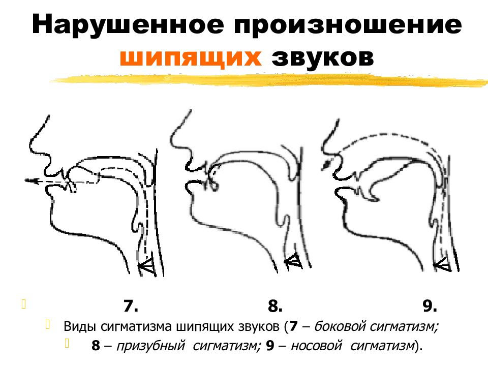 Нарушение артикуляционных схем отдельных звуков является первичным дефектом при