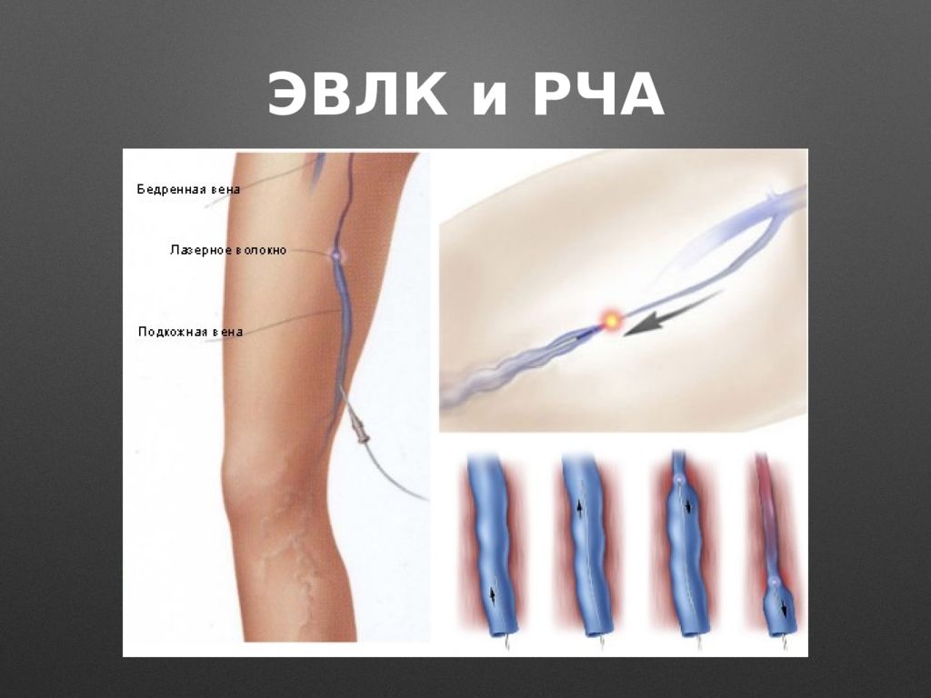 Эндовенозная коагуляция вен нижних конечностей. Лазерная облитерация (коагуляция) вен. ЭВЛК лазерная коагуляция варикозных вен. Лазерная коагуляция ЭВЛК что это. Эндовазальная лазерная коагуляция вен (ЭВЛК).