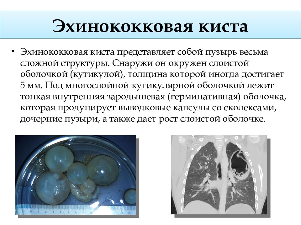 Эхинококкоз легких презентация