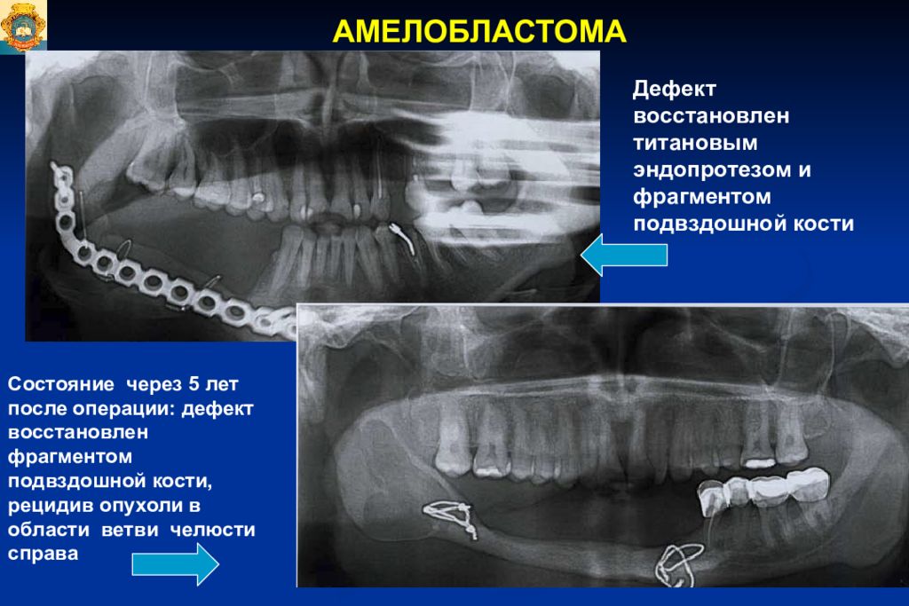 Рецидив кости. Амелобластома (адамантинома). Амелобластома челюсти рентген. Амелобластома верхней челюсти кт. Амелобластома нижней челюсти кт.