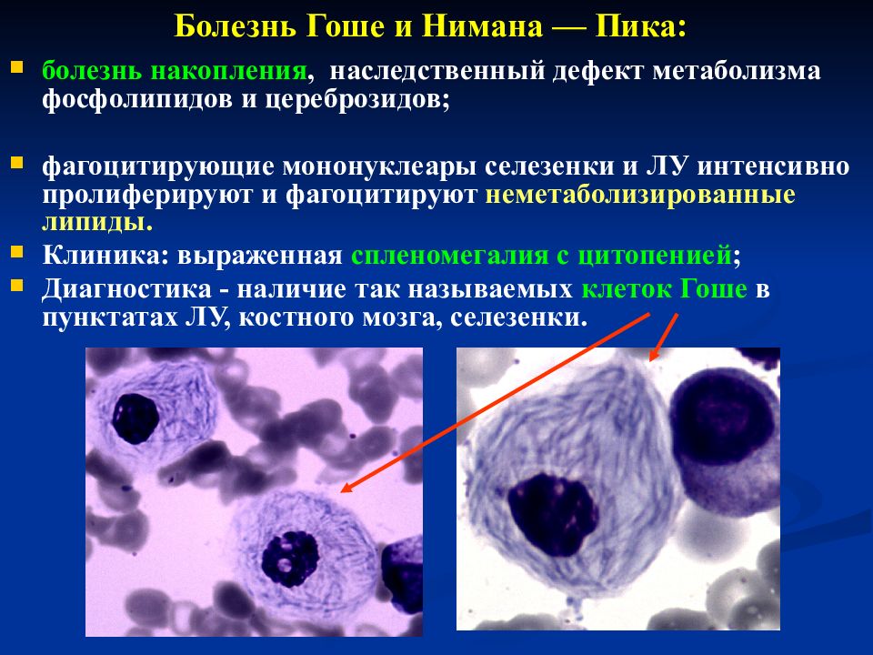 Клетки накопления. Клетки Гоше в костном мозге. Клетка при болезни Гоше.