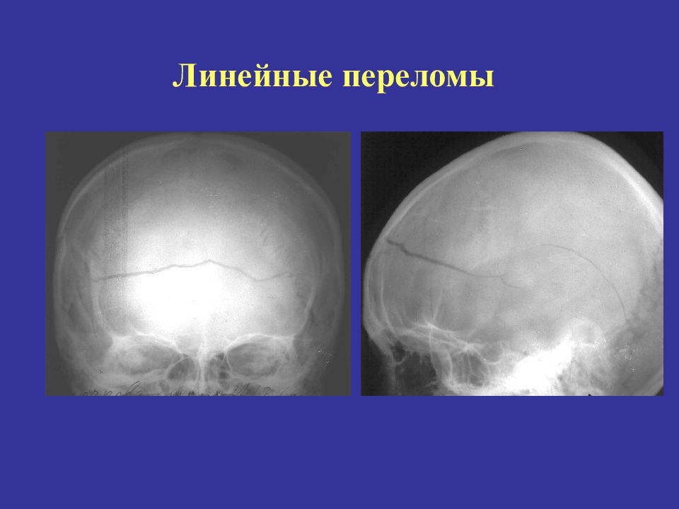 Линейная трещина. Вдавленный перелом свода черепа. Перелом теменной кости черепа рентген. Паутинообразный перелом черепа. Перелом костей черепа рентген.