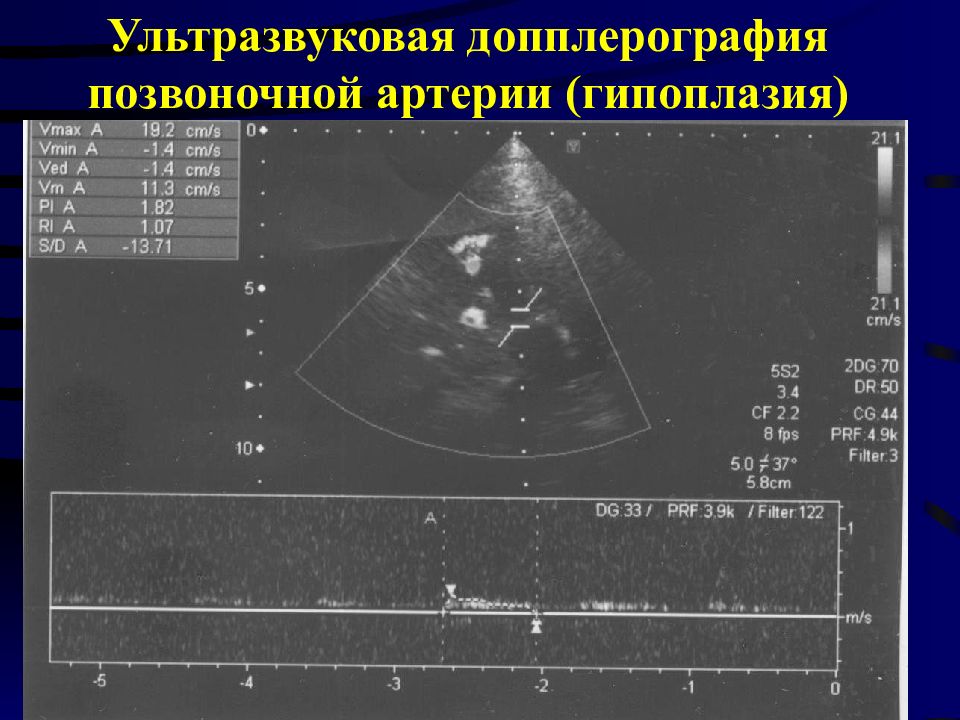 Допплерография это. Ультразвуковая допплерография позвоночных артерий. УЗДГ позвоночной артерии. Ультразвуковая анатомия позвоночных артерий. Допплерография физиология.