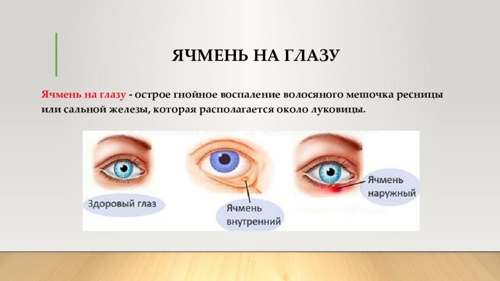 Глаз ячмень чем лечить в домашних условиях. Ячмень заболевание глаз. Воспаление глаза ячмень. Этапы развития ячменя на глазу.