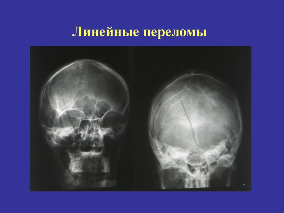 Линейная трещина. Линейный перелом костей свода черепа. Перелом свода черепа рентген. Линейный перелом затылочной кости черепа. Перелом теменной кости черепа рентген.