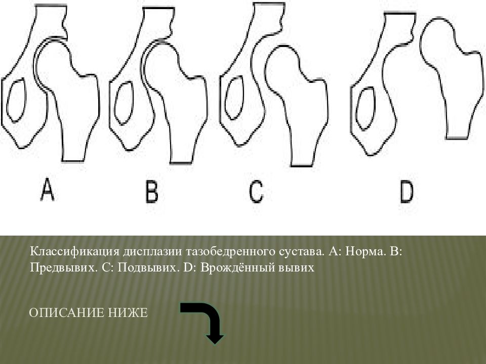 Презентация дисплазия тазобедренных суставов