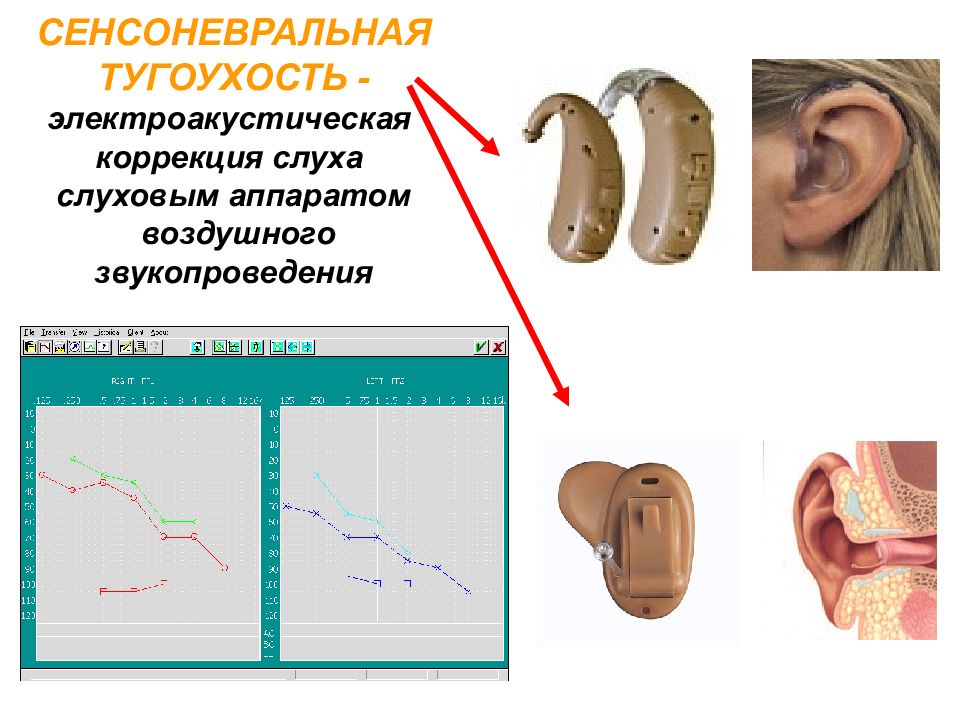 Картинки нейросенсорная тугоухость