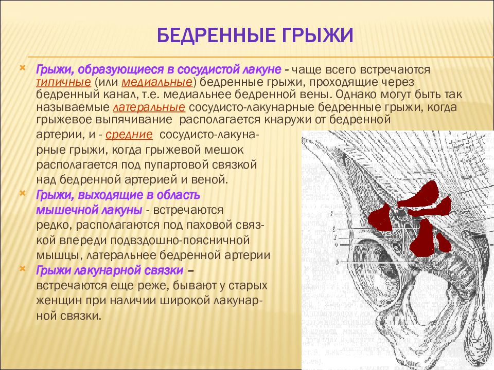 Паховая грыжа у мужчин где находится картинка причины симптомы и причины