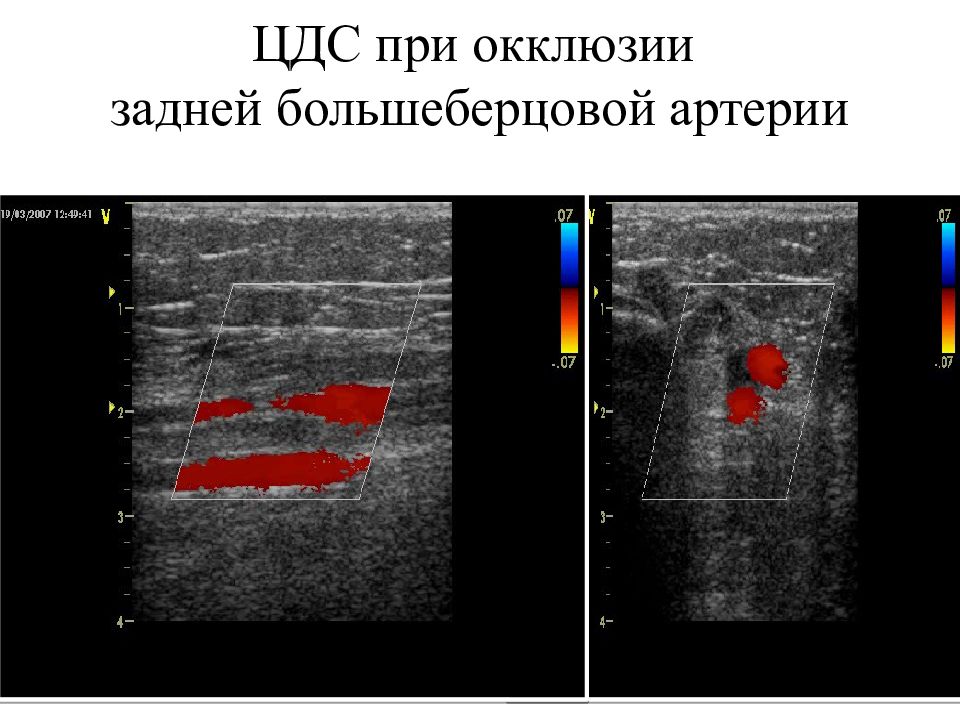 Окклюзия нижних конечностей. Задняя большеберцовая артерия на УЗИ. Окклюзия артерии тыла стопы УЗИ. УЗИ периферических сосудов. Окклюзия берцовых артерий.