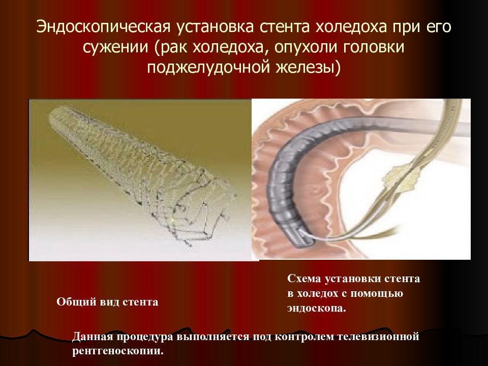 Установка стента. Стент поджелудочной железы. Эндоскопическое стентирование. Стентирование поджелудочной железы.