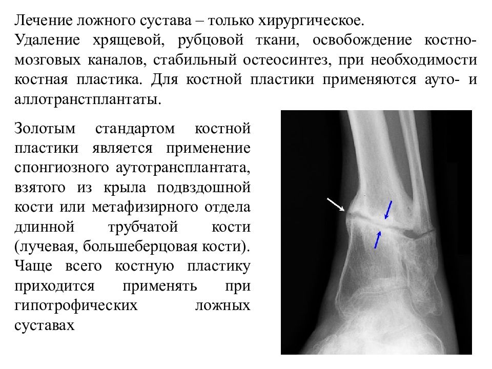 Ложный сустав. Симптомы ложного сустава локтевой кости. Рентгенологические признаки ложного сустава. Рентгенологическими признаками ложного сустава являются:.