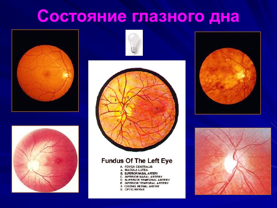 Глазное дно презентации