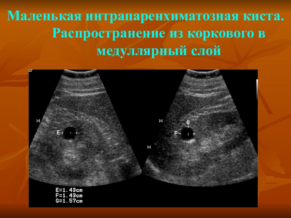 Кисты почек причины возникновения