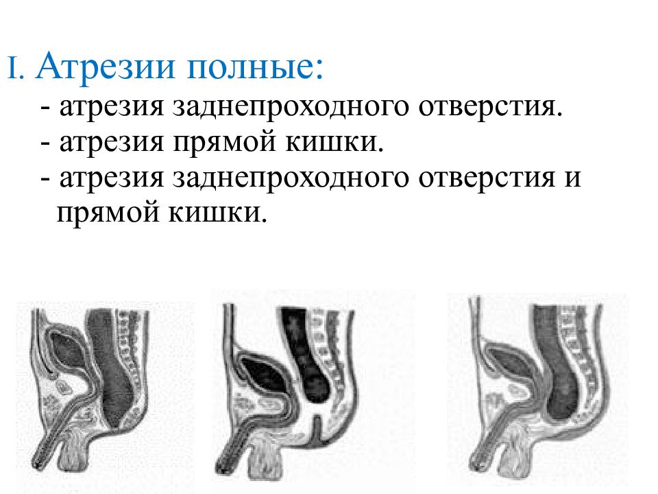 Прямая кишка у новорожденного. Атрезия прямой кишки у новорожденных. Атрезия заднего прохода и прямой кишки. Пороки развития прямой кишки. Дети с атрезией заднего прохода и прямой кишки.