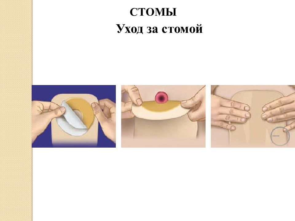 Стомы виды стом уход за стомами презентация