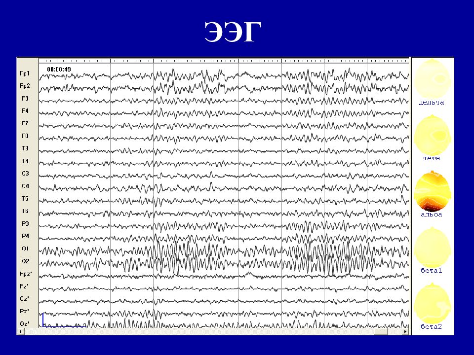 Ритмы ээг. Ритм цыганенка на ЭЭГ. Электроэнцефалография (ЭЭГ) метод. Электроэнцефалограмма презентация. Основные ритмы ЭЭГ.