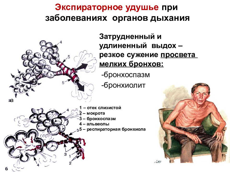 Экспираторная одышка тест аккредитация. Признак, характерный для экспираторной одышки. Экспираторная одышка патогенез. При экспираторной одышке затруднен. Экспираторный коллапс бронхов.