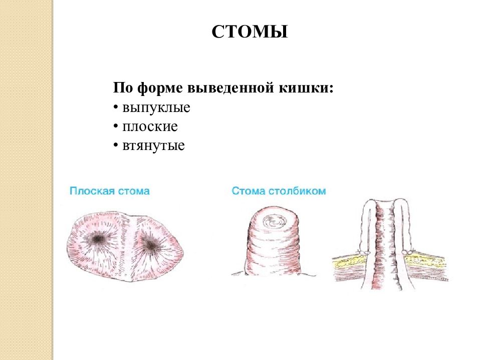 Выведен кишечник. Выпуклые, плоские, втянутые стомы. Стомы по форме выведенной кишки. По форме вывода кишки стомы.