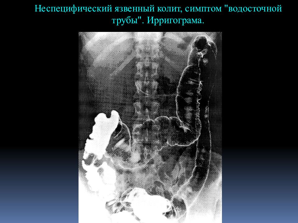 Клиническая картина хронического колита