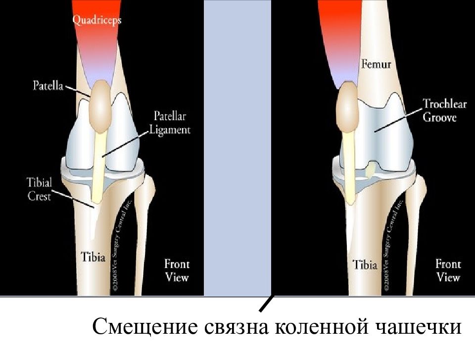 Смещение коленного сустава. Смещение чашечки коленного сустава. Сдвиг коленной чашечки. Коленный сустав сдвигается. Правильное положение коленной чашечки.