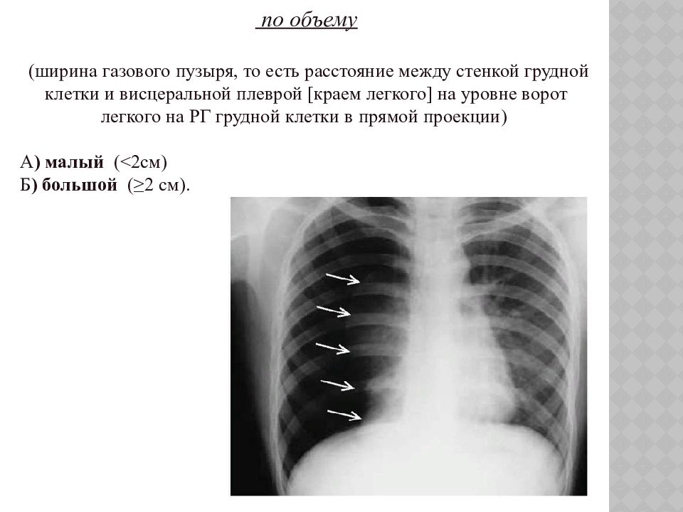 Края легкого