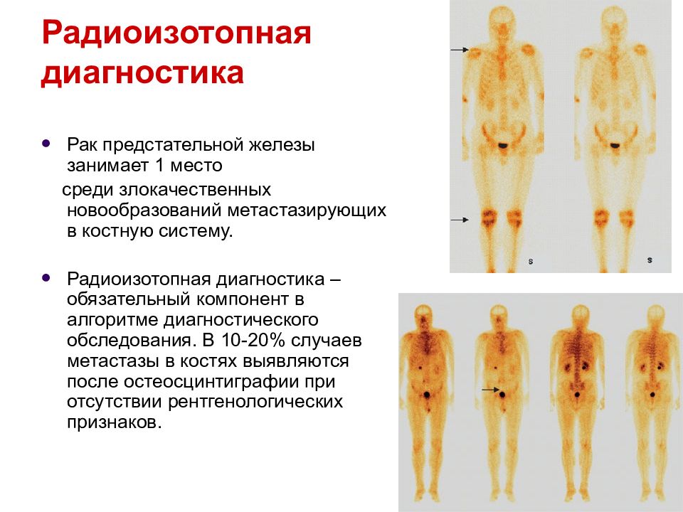 Остеосцинтиграфия при раке молочной железы