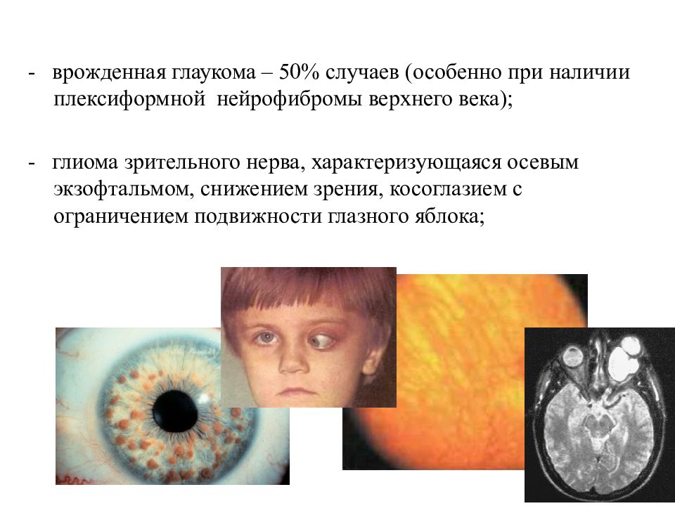 Наследственные заболевания зрения. Глиома зрительного нерва. Глаукома наследственное заболевание. Нейрофиброматоз глиома зрительного.