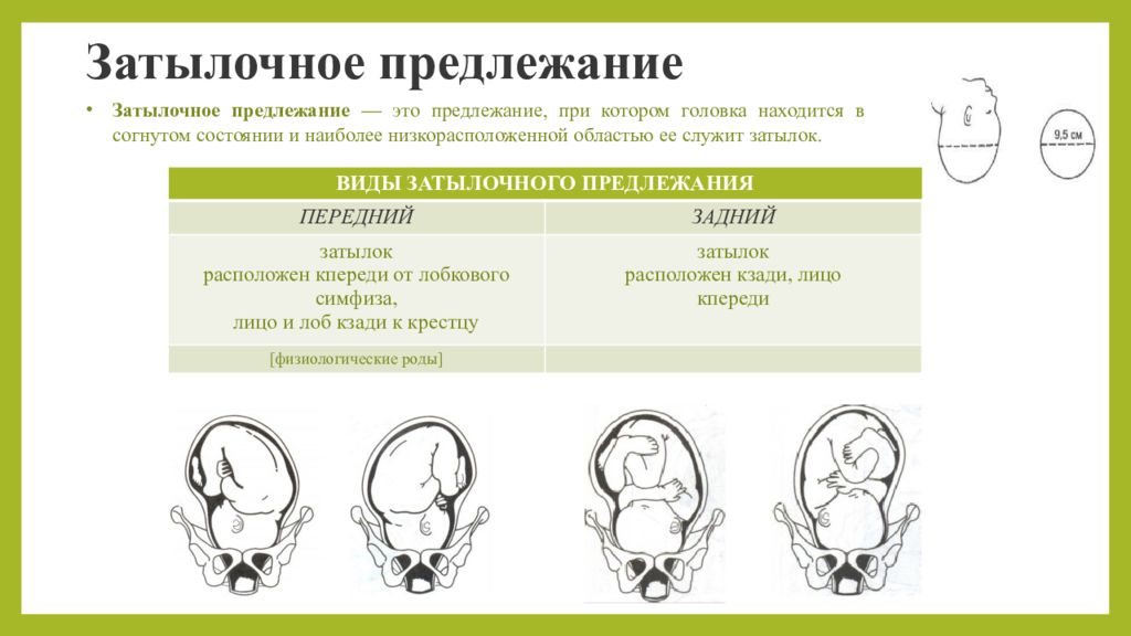 Роды в затылочном предлежании фото