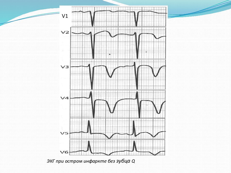 Патологический зубец q при инфаркте. Инфаркт миокарда без зубца q на ЭКГ. Инфаркт с зубцом q и без зубца q ЭКГ. Инфаркт миокарда с зубцом q на ЭКГ. Зубец QS на ЭКГ В v1 v2.