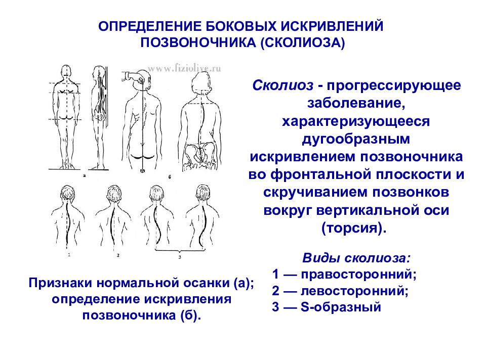 Искривление во фронтальной плоскости