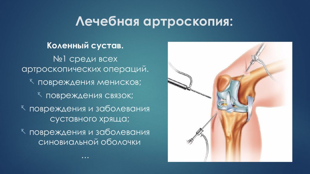 Операции на коленном суставе стоимость. Операция на мениске артроскопия. Артроскопия коленного сустава протокол операции. Артроскопия мениска колена.