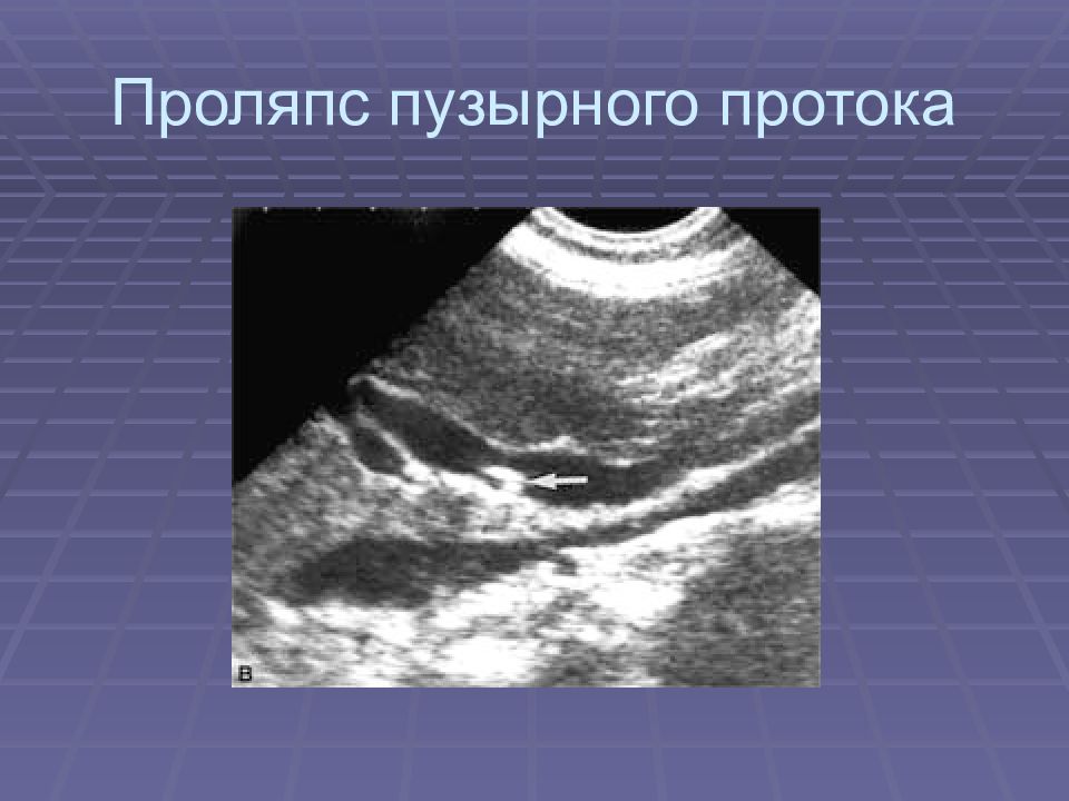 Узи в каменском. Пузырный занос УЗИ картина. Пузырный занос УЗИ протокол. Частичный пузырный занос УЗИ картина.