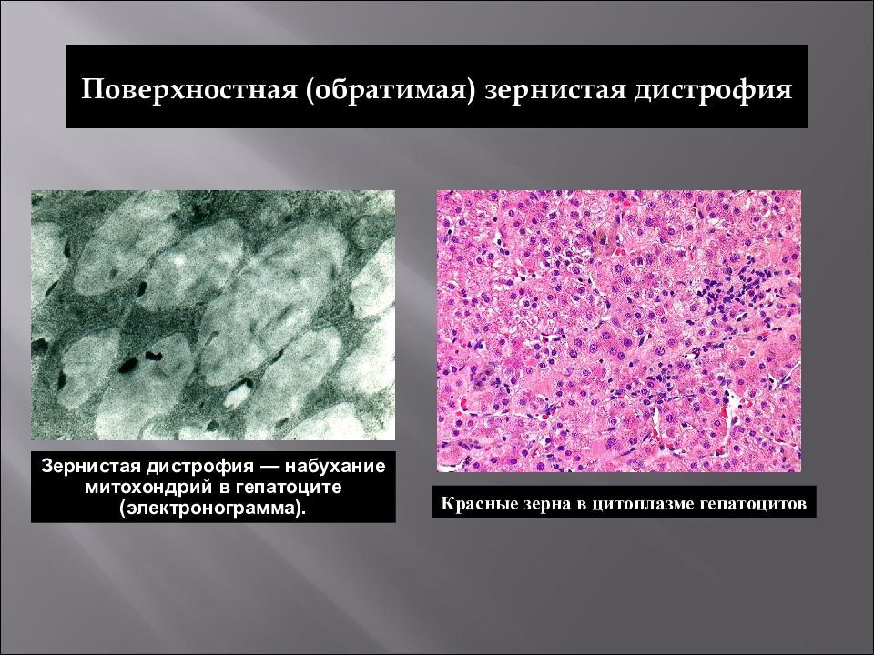 Повреждения дистрофии презентация