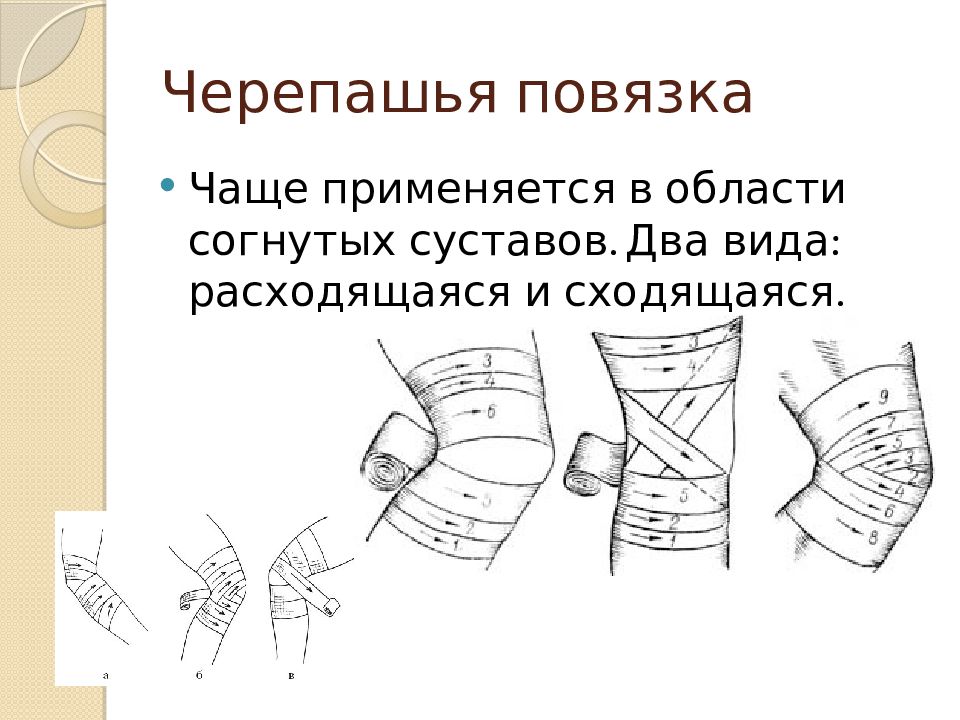 Черепашья расходящаяся повязка на коленный сустав. Десмургия черепашья повязка. Черепашья повязка расходящаяся алгоритм. Черепашья повязка на нижнюю конечность.