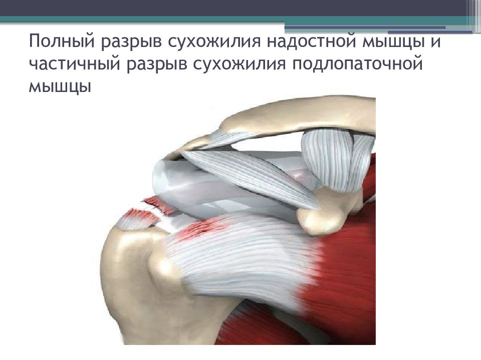 Лечение частичного разрыва мышц. Повреждение сухожилия надостной мышцы. Разрыв сухожилия надостной мышцы плечевого сустава. Сухожилие ротаторная манжета. Повреждение сухожилия подлопаточной мышцы.