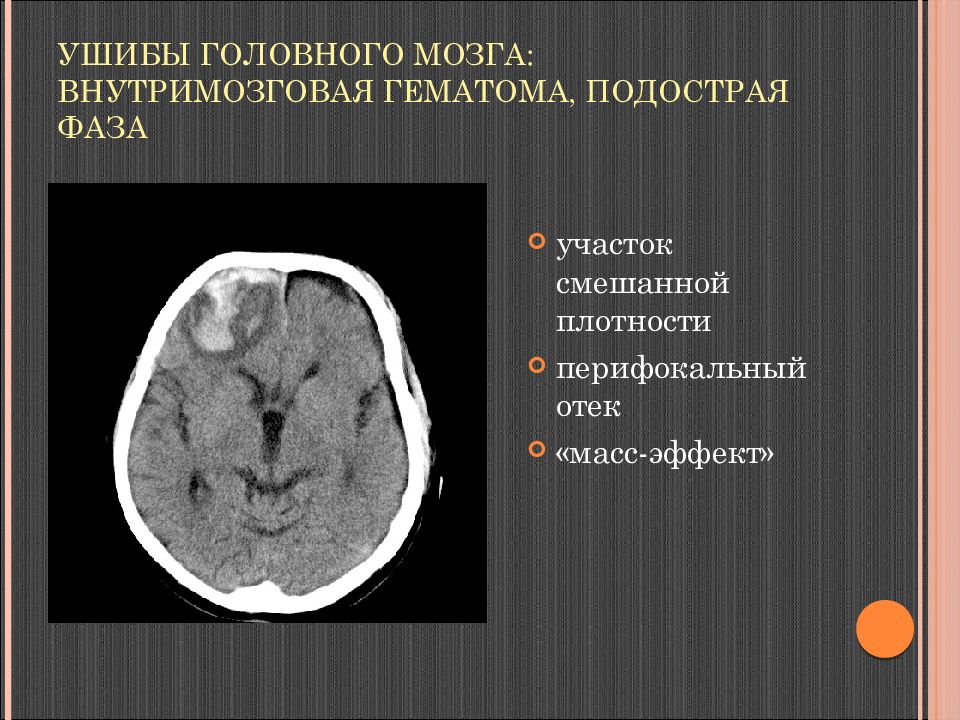 Гематома мозга. Внутримозговая гематома кт. Гематома в головном мозге. Гематома головного мозга кт.