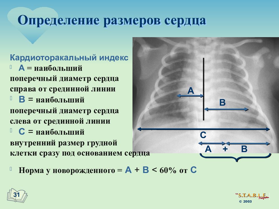 Размеры сердца. КТИ норма в рентгене. КТИ рентген норма сердце. Кардиоторакальный индекс. Корокоторакальный индекс.