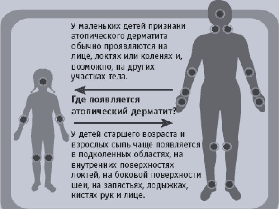 Атопический дерматит у детей презентация