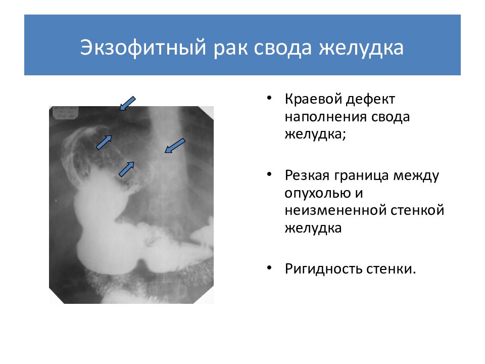 Рентгенологическая картина рака пищевода экзофитный эндофитный