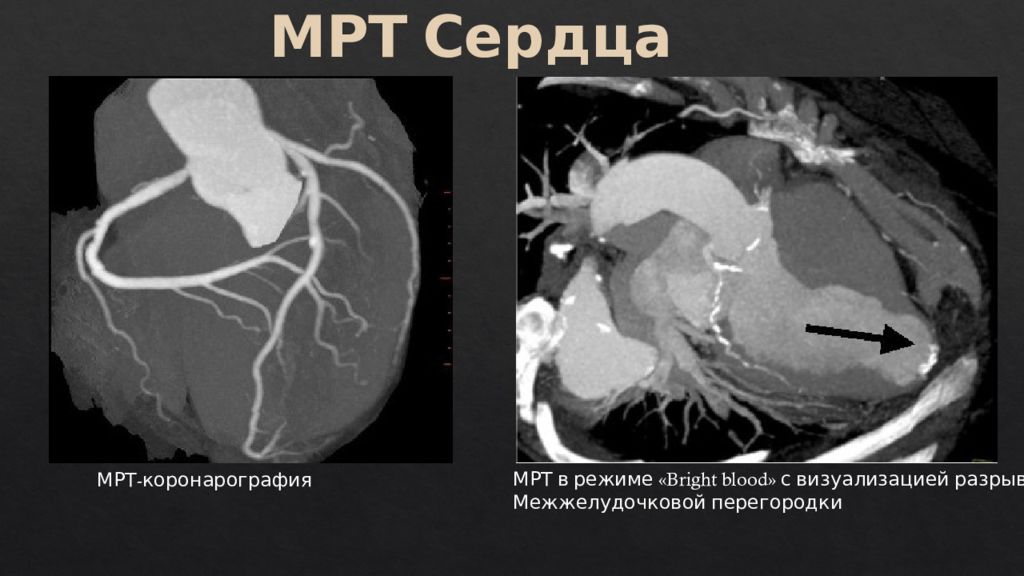 Мрт сердца. Магнитно-резонансная томография сердца и магистральных сосудов. Мрт сердца и магистральных сосудов.