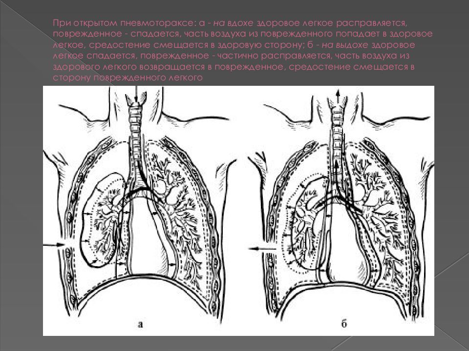Клапанный пневмоторакс презентация