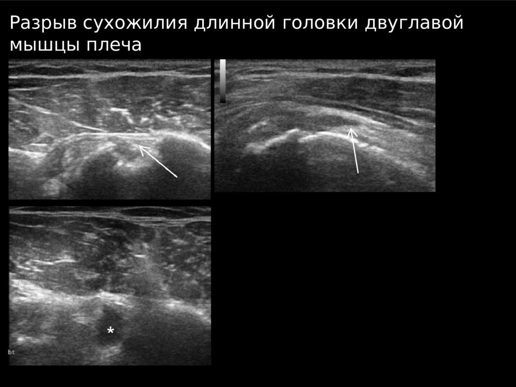 Узи плечевого сустава в минске. УЗИ плечевого сустава презентация.