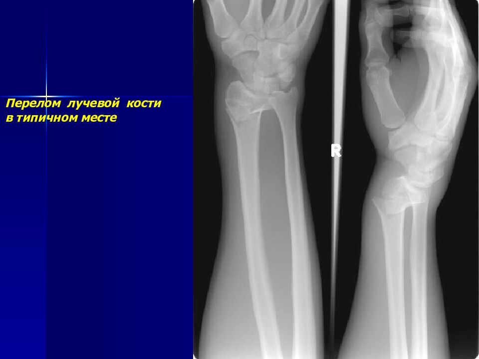 Диагноз перелома лучевой кости